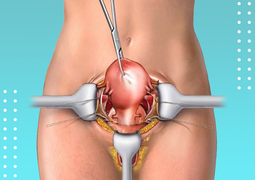 Abdominal Hysterectomy - Uterus Removal Surgery In Ludhiana