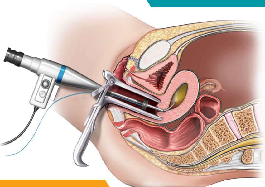 Hysterectomy (Uterus Removal Surgery) in Ludhiana, Punjab