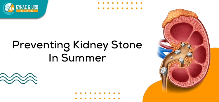 Urologist Tips: What are the tips to prevent kidney stones in summer?