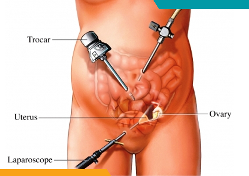 Total Laparoscopic Hysterectomy in Ludhiana, Punjab